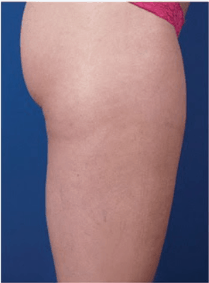 after derma