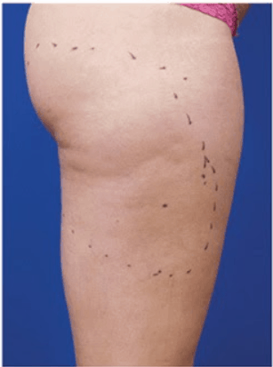 before derma
