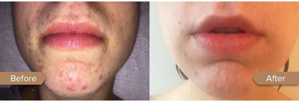 glow peel