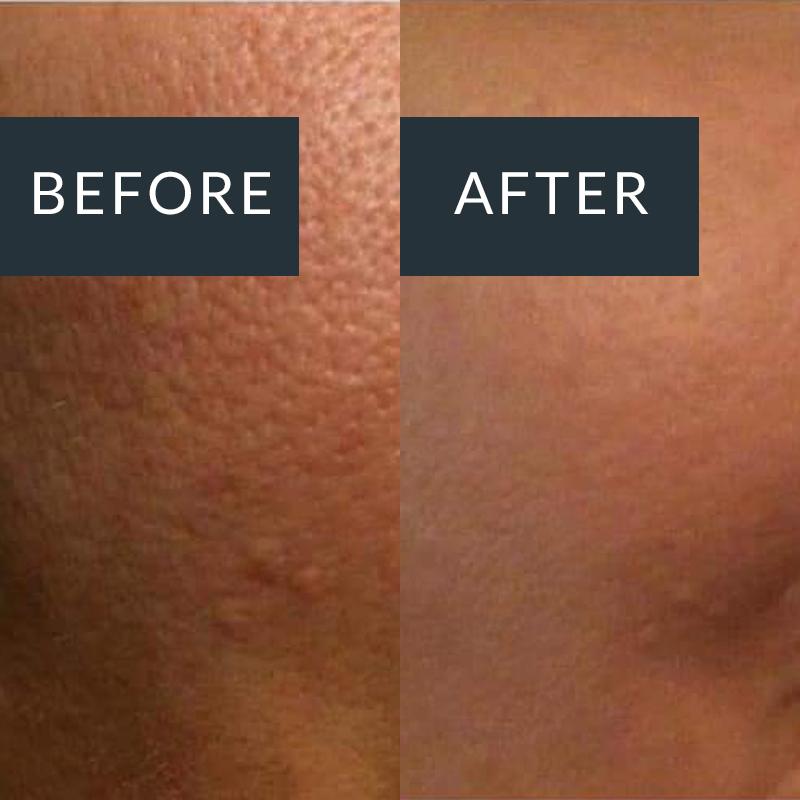 Acne Scarring