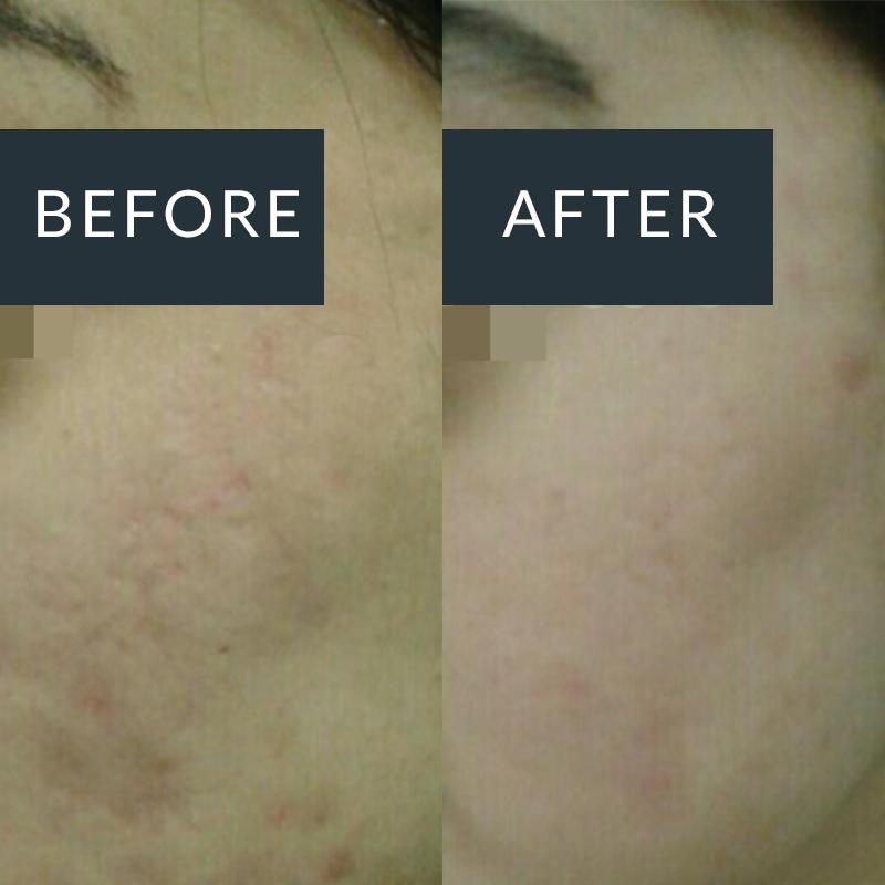 Acne Scarring