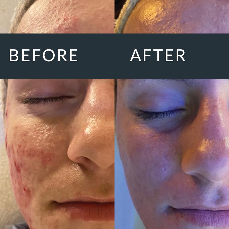 Acne Scarring