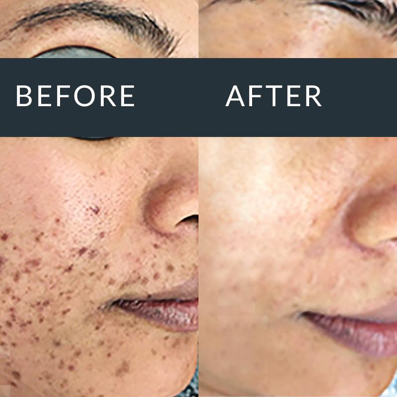 Dermapen Micro Needling - Dermal Aesthetics Clinic Dermapen Micro Needling - Dermal Aesthetics Clinic
