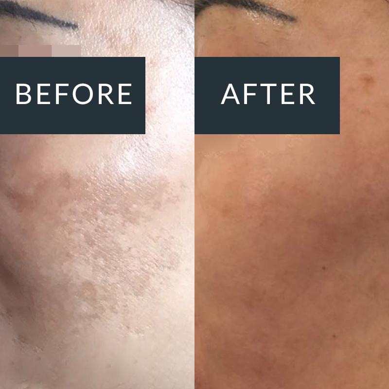 Pigmentation