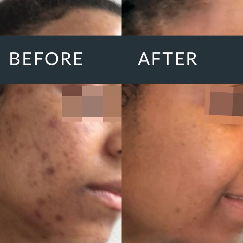 Pigmentation