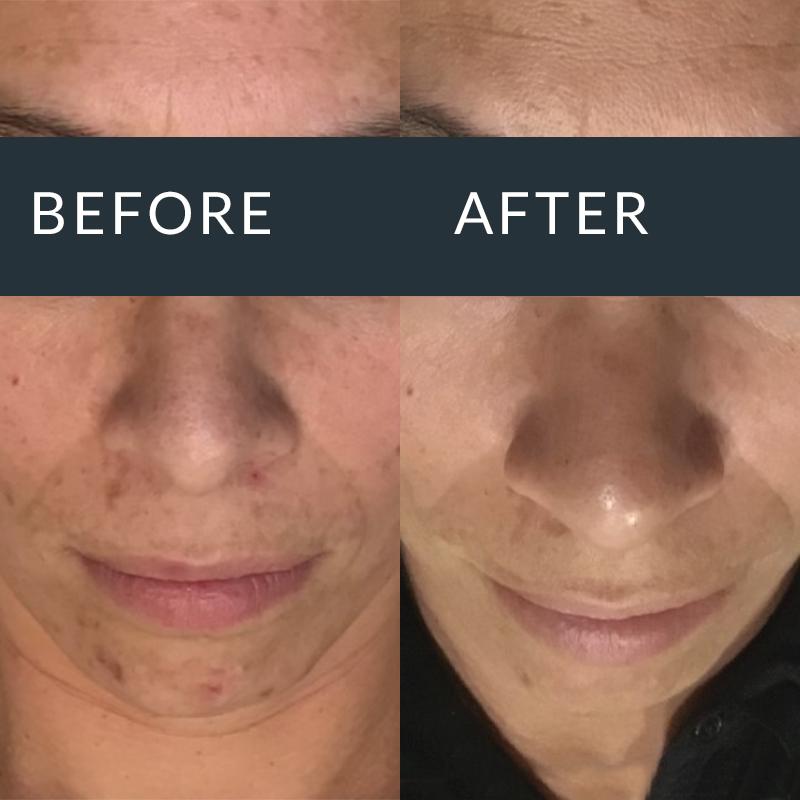 Pigmentation