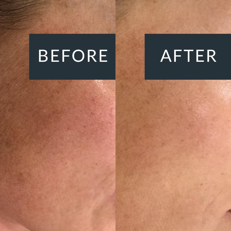Pigmentation