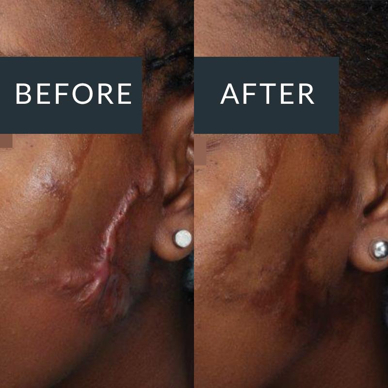 Acne Scarring