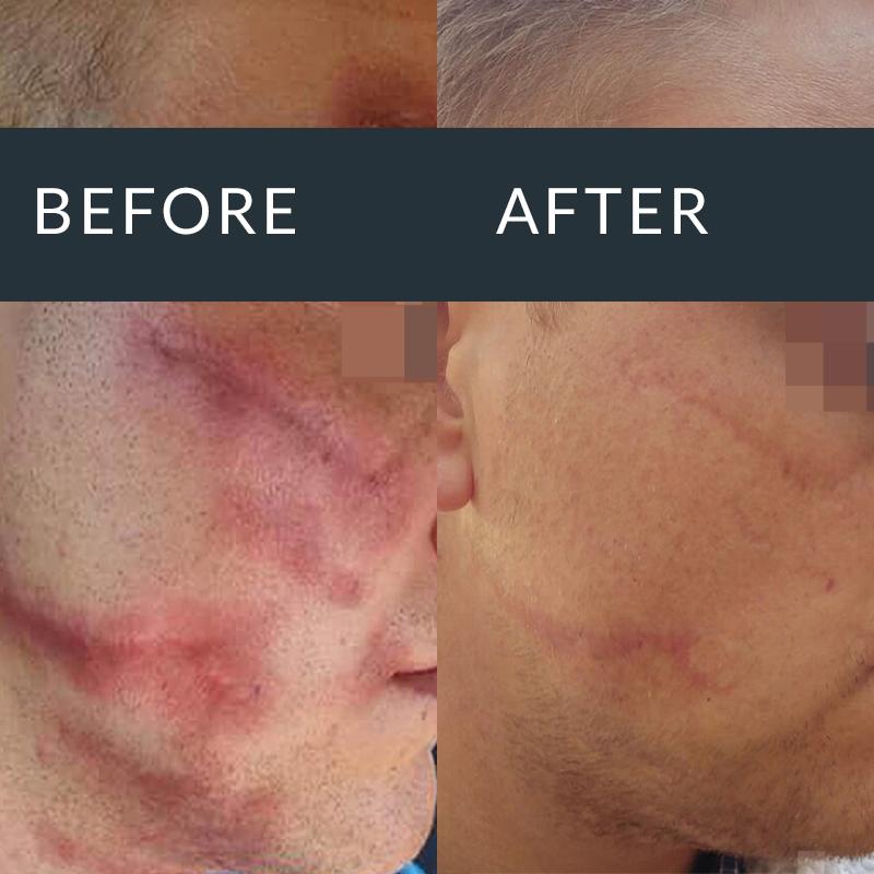 Acne Scarring
