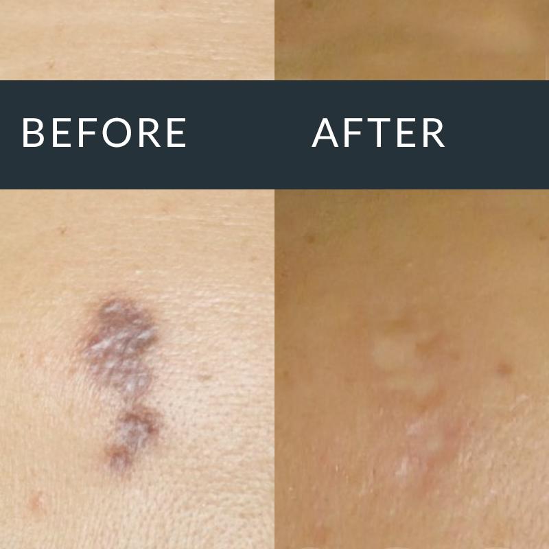 Acne Scarring