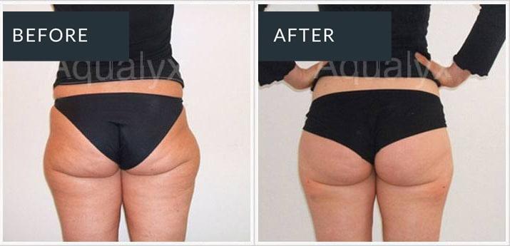 Aqualyx before and after