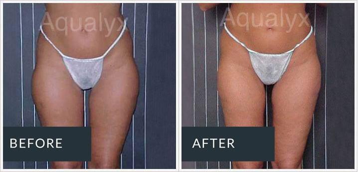 Aqualyx before and after