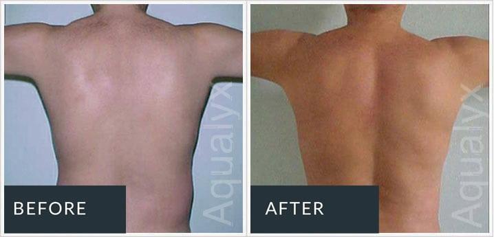 Aqualyx before and after
