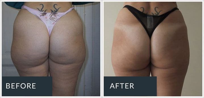 Aqualyx before and after