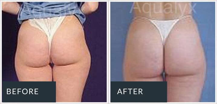 Aqualyx before and after