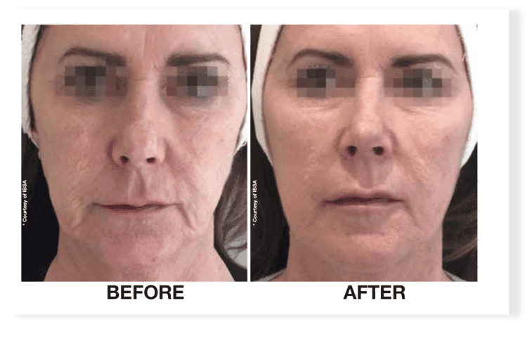 profhilo before after 1 daclinic