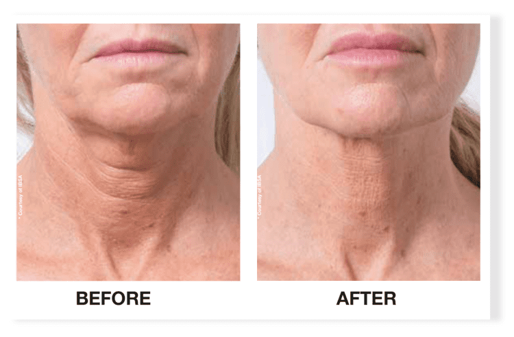 profhilo before after 2 daclinic