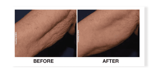 profhilo before after 3 daclinic