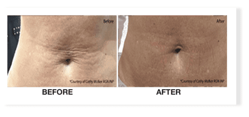 profhilo before after 4 daclinic