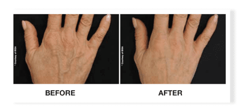 profhilo before after 5 daclinic