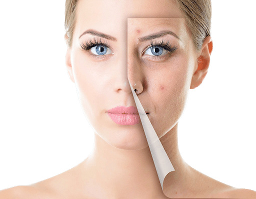 acne scarring treatment