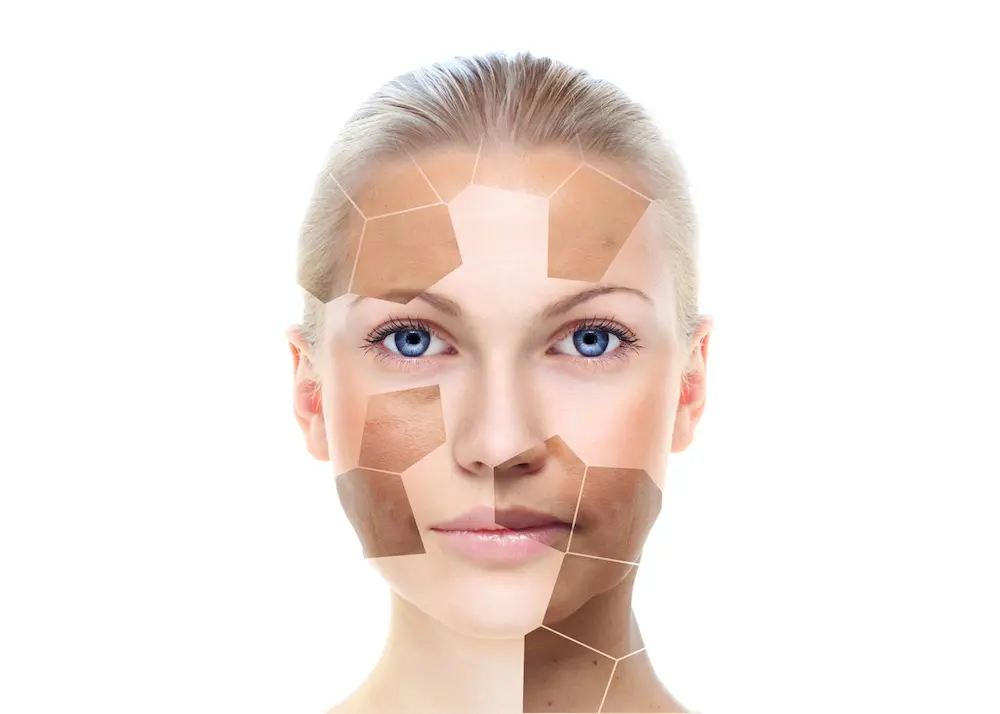 hyperpigmentation treatment