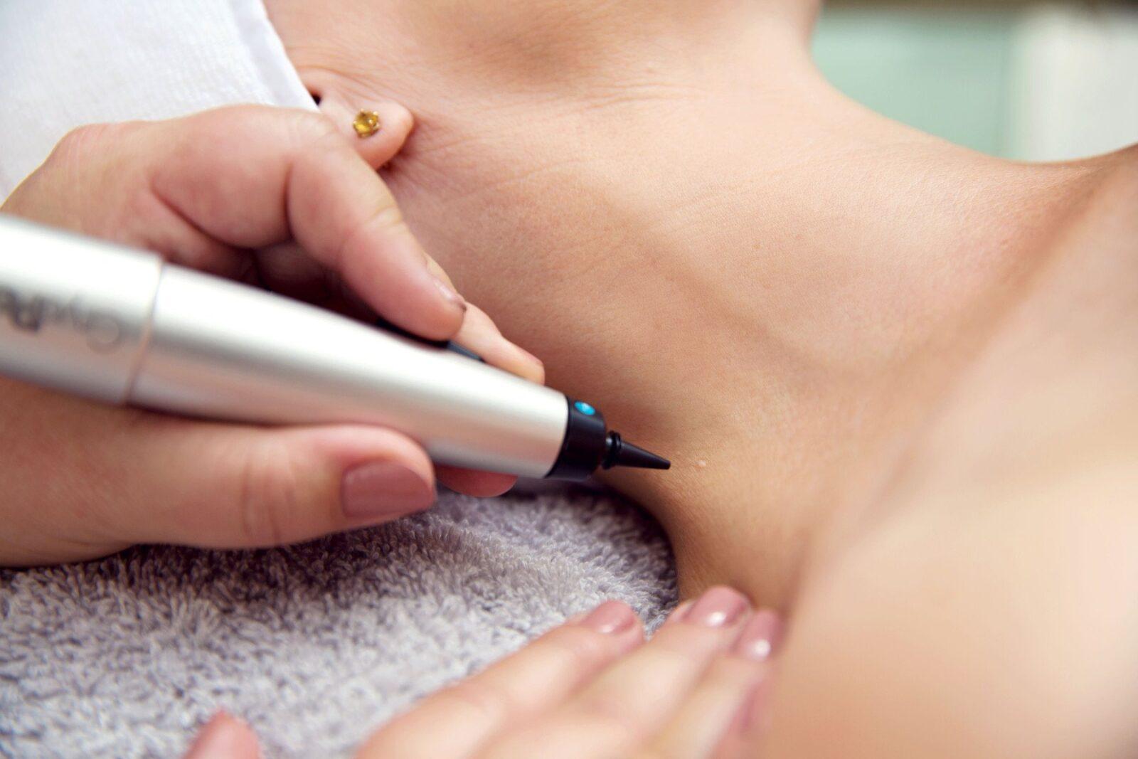 CryoPen Treatment Pen