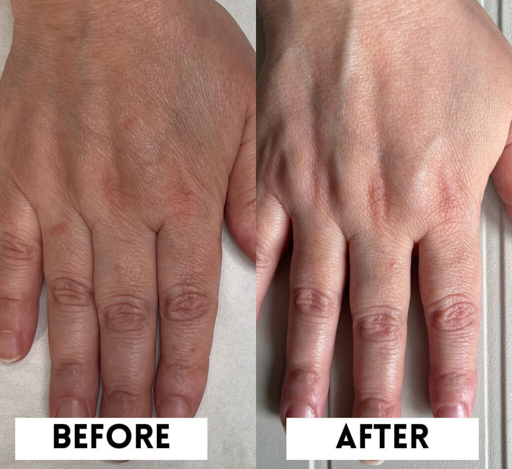 seventy hyal hand rejuvenation