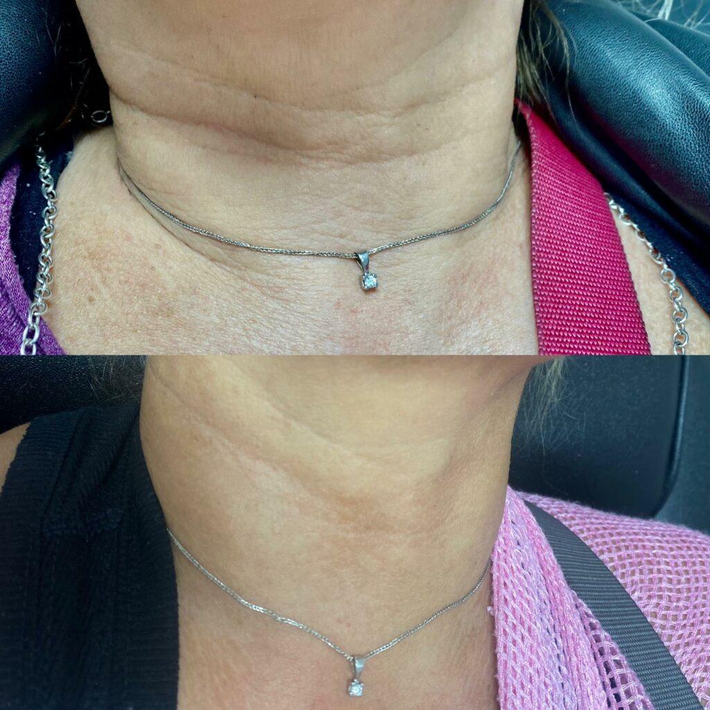 seventy hyal neck treatment
