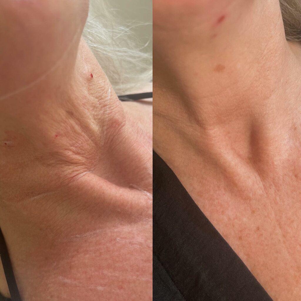 seventy hyal neck treatment 3